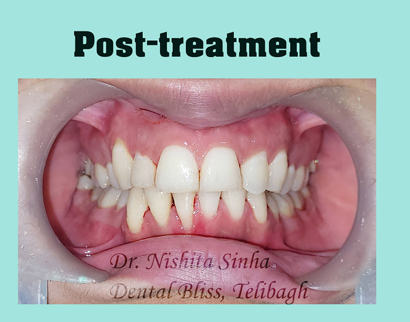 Braces-treatment-post