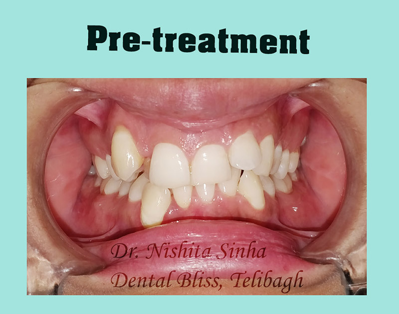 Braces-treatment-pre