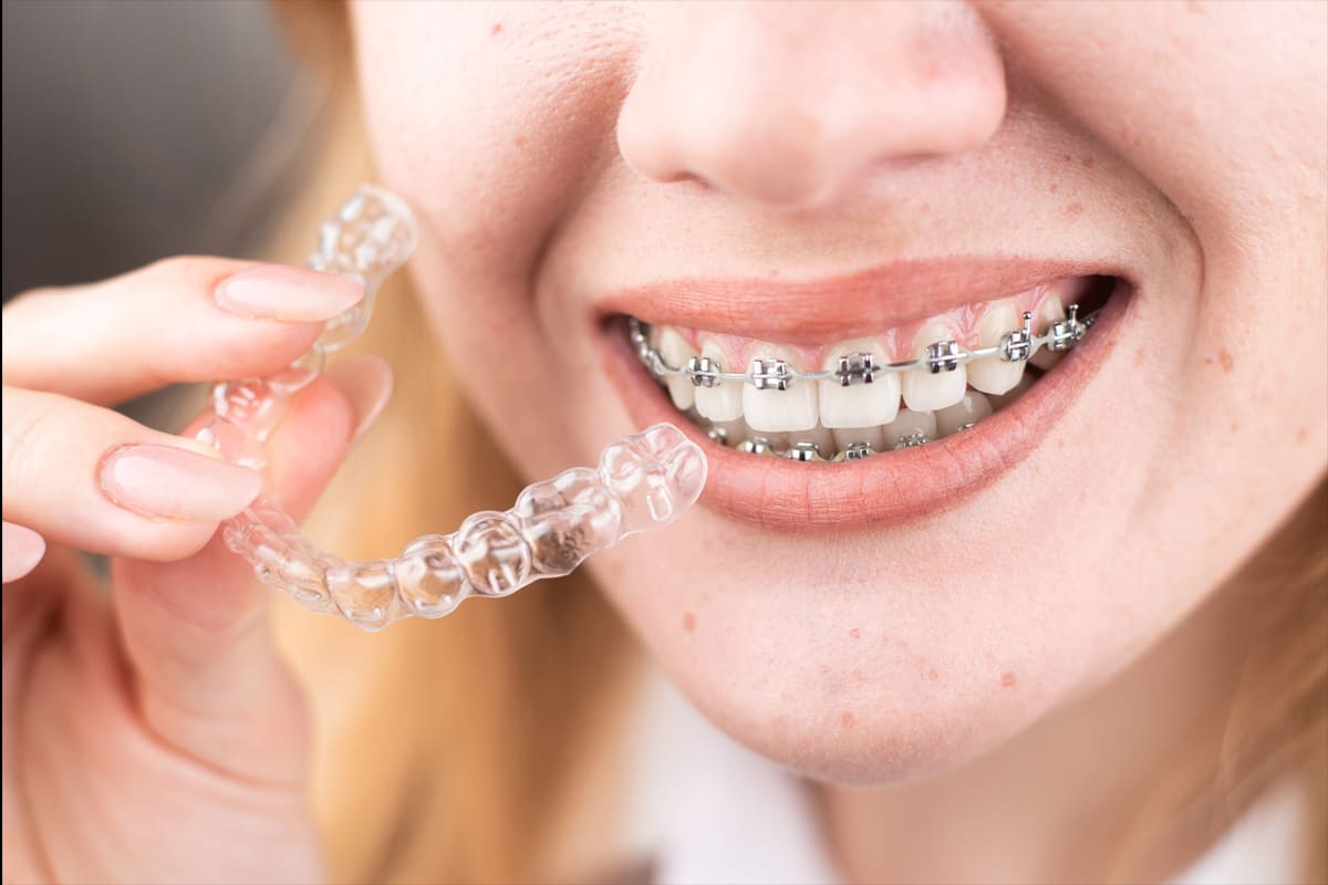 braces-clear-aligners