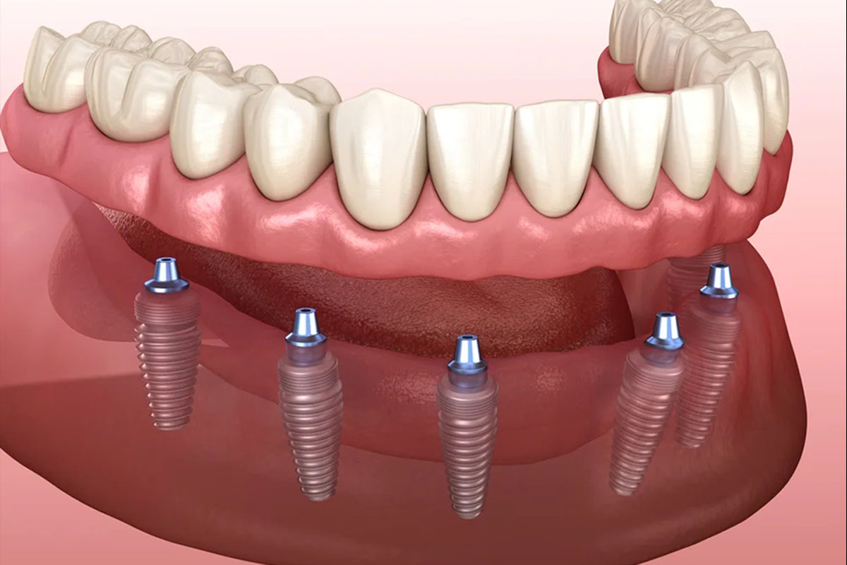 dental-implants-full-mouth-rehabilitation.aspx