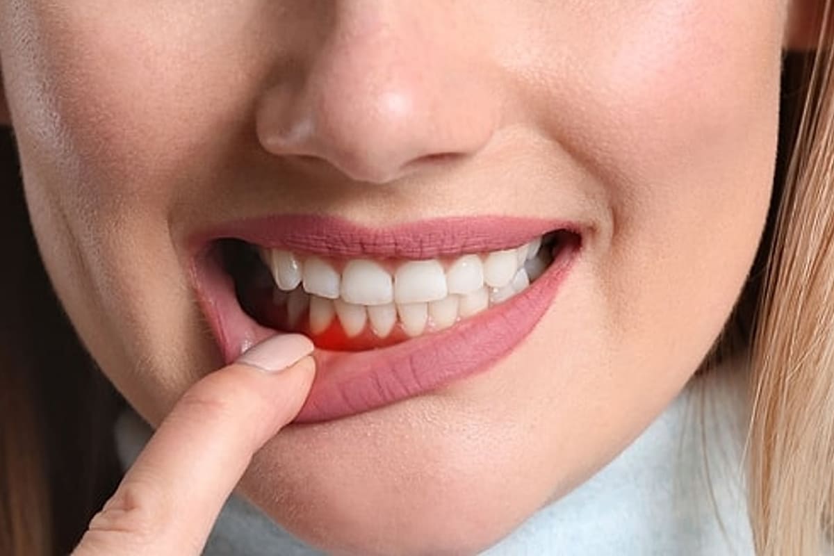 gum-care-periodontal-therapy