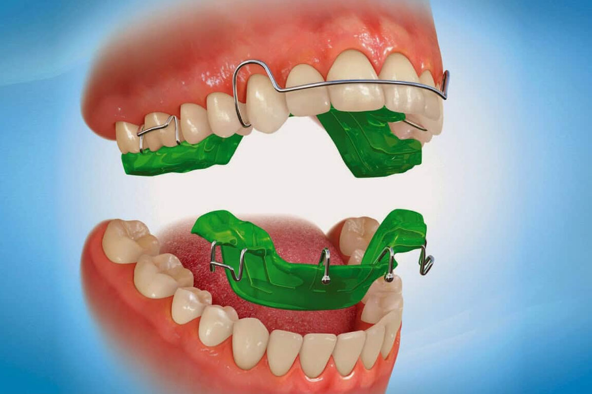 myofunctional-appliances
