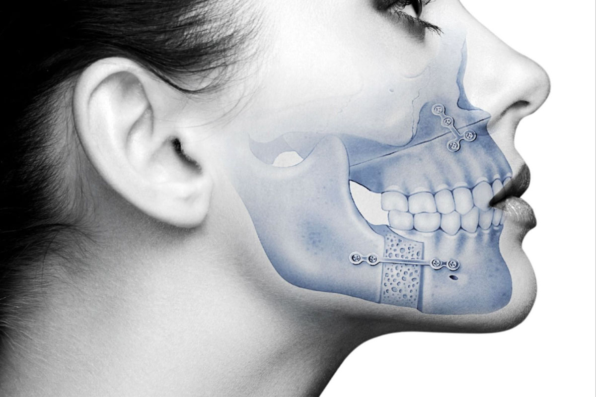 orthognathic-surgery