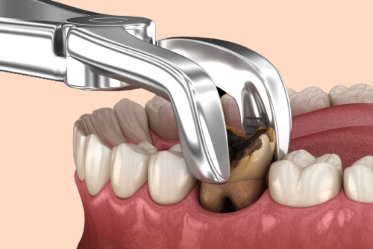 tooth-extraction